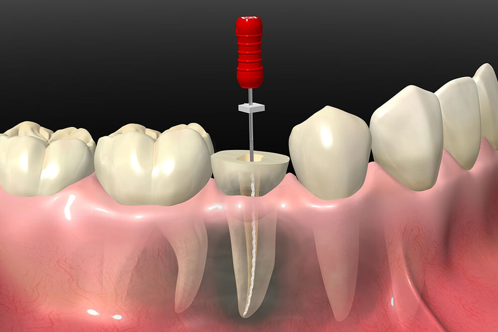 歯 根っこ の 治療