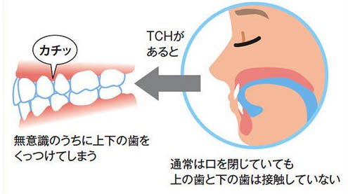 矢口渡・池上・蓮沼・武蔵新田・蒲田の歯医者、のびのび歯科・矯正歯科の歯列接触癖対策